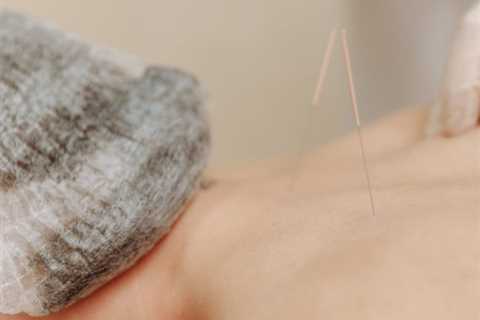 HOW TO USE ACUPUNCTURE FOR BACK PAIN MANAGEMENT